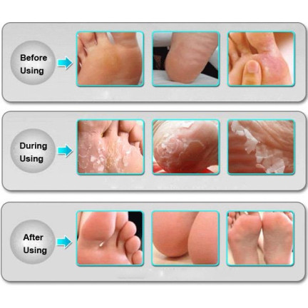 CC99 Peeling-Socken für die Füße
